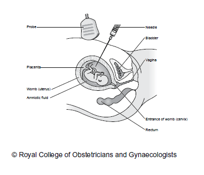 Figure 3: Amniocentesis